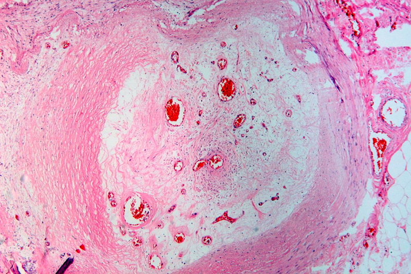 An occluded artery of the lower leg by an old organized thrombus in peripheral vascular disease. Credit: Wikimedia user Pathos