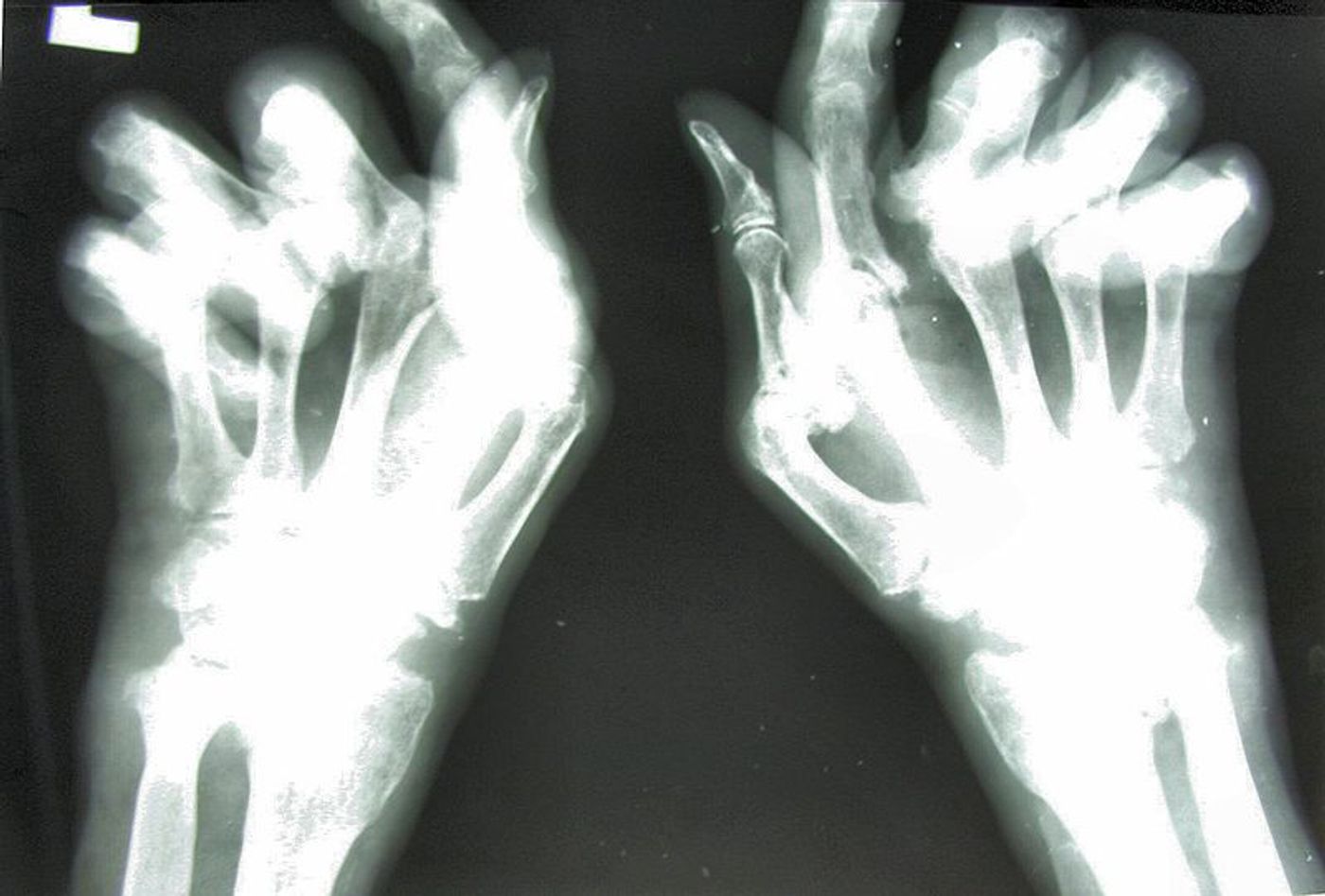 Rheumatoid arthritis: X-ray image of the hand with large changes in destructive arthritis.