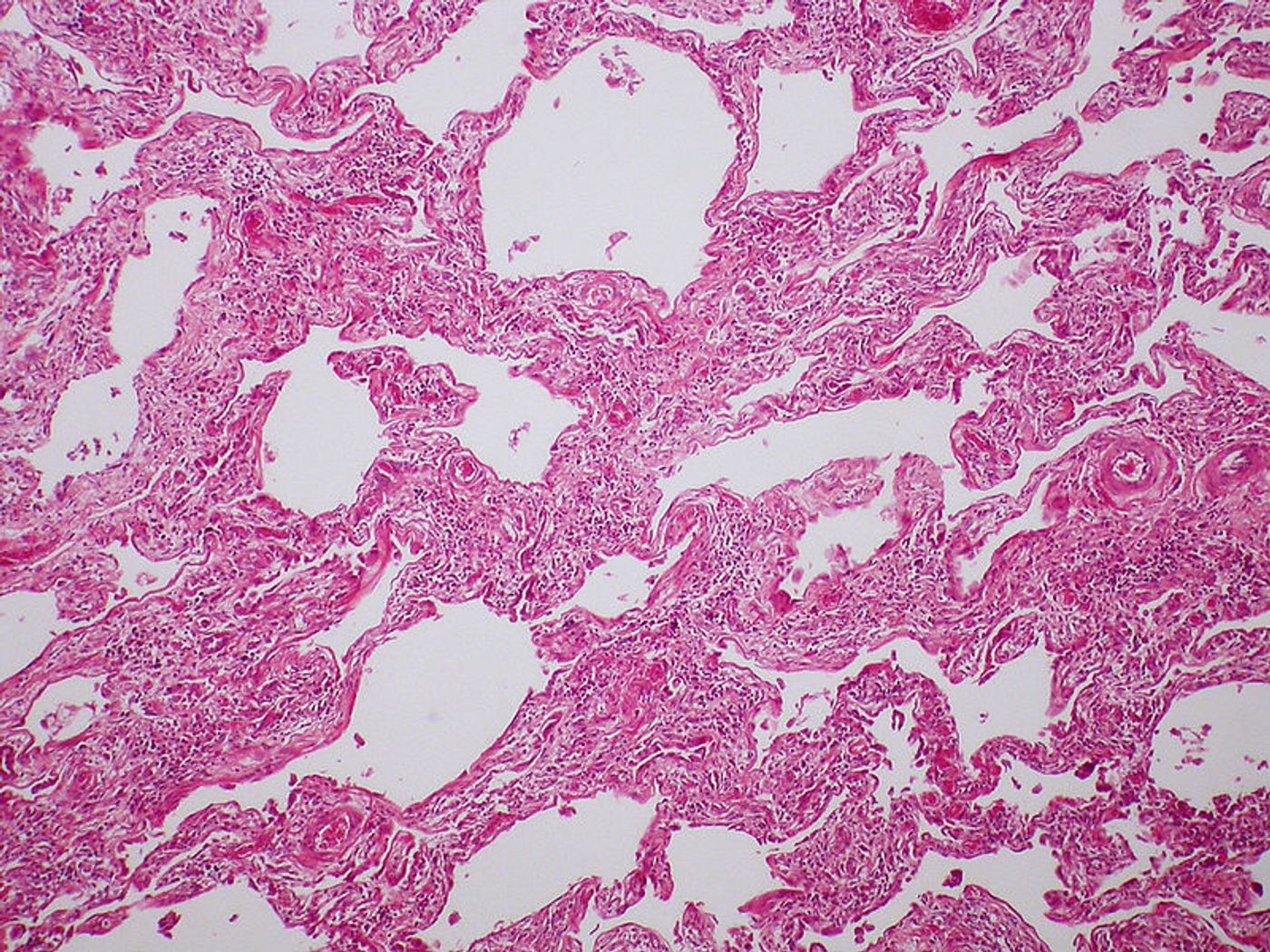  Interstitial pulmonary fibrosis in Scleroderma. Credit: Yale Rosen