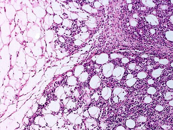 Subcutaneous panniculitis-like T-cell lymphoma. Credit: L. Wozniak & K.W. Zielinski