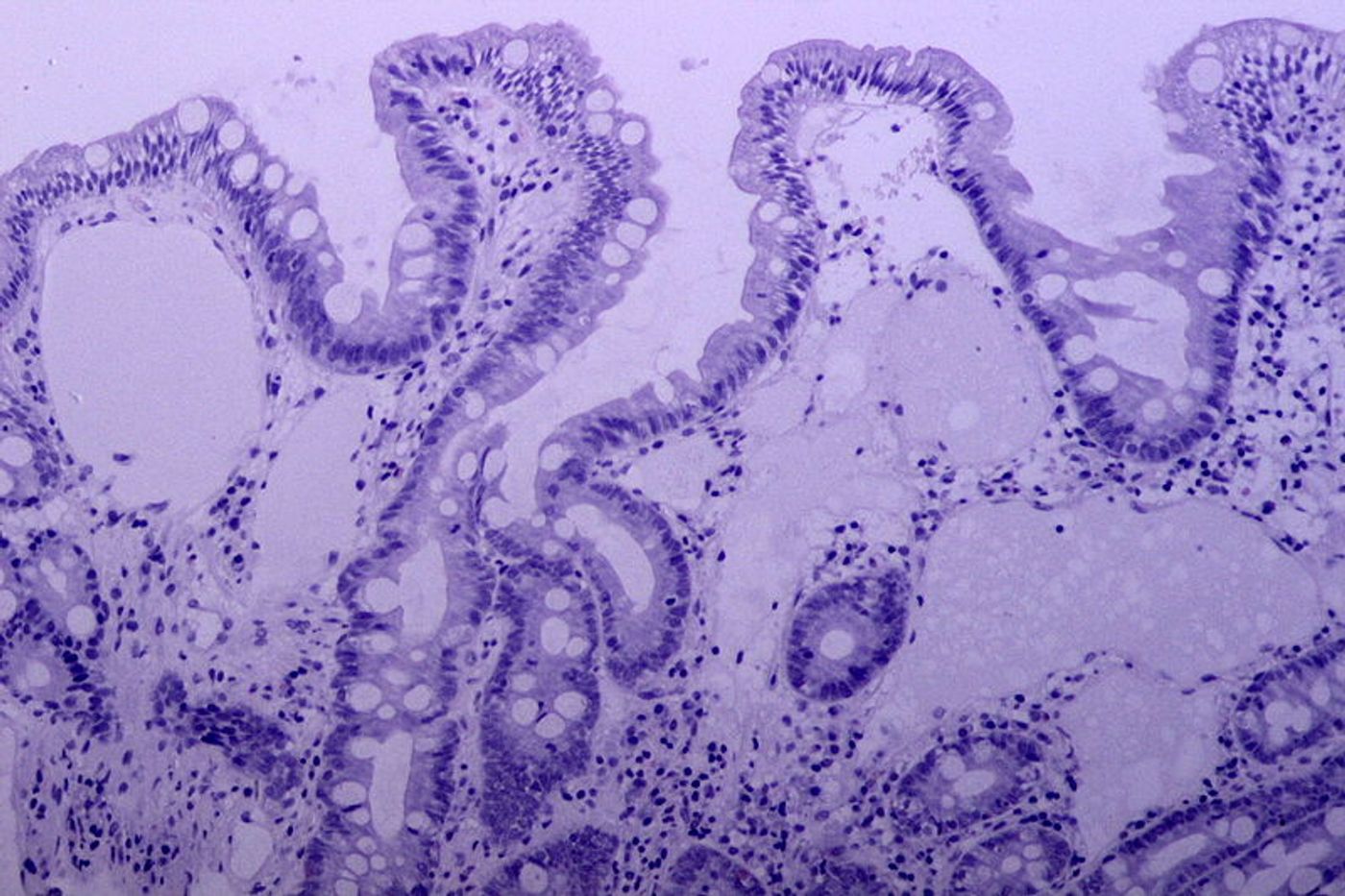 Intestinal lymphangioma. Credit: Wikimedia User Pathos