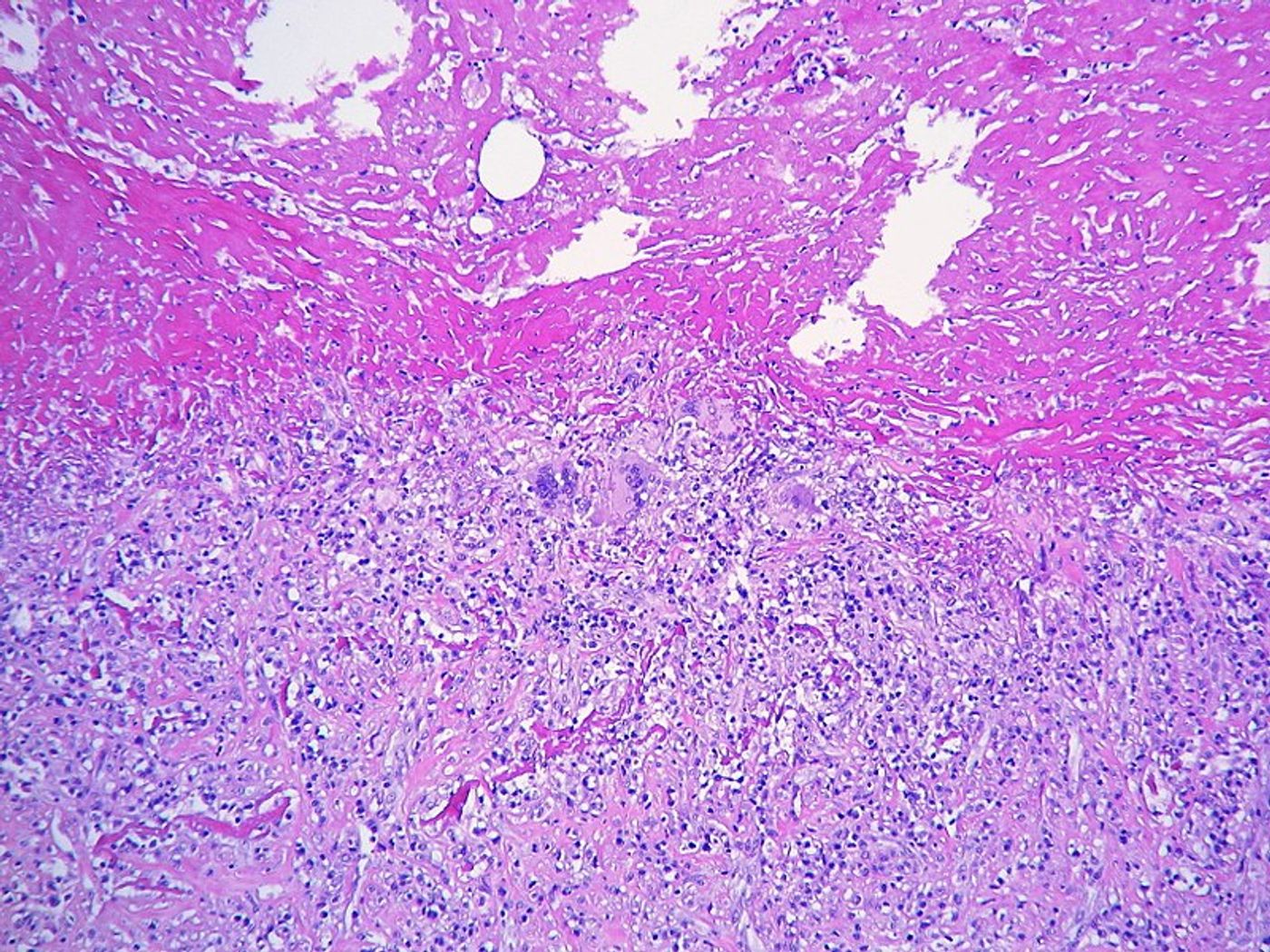 Histopathology of tuberculosis-infected lung tissue, specifically inflammation in the tissue lining the lungs. Credit: Yale Rosen