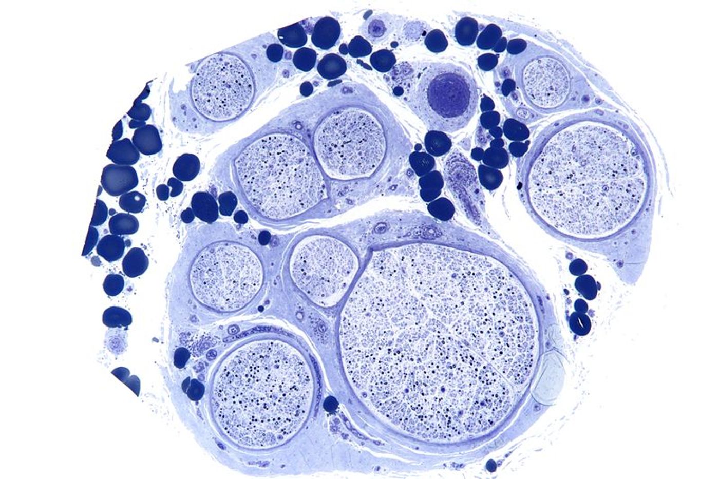 Low magnification micrograph of a vasculitic neuropathy. Credit: Wikimedia User Nephron