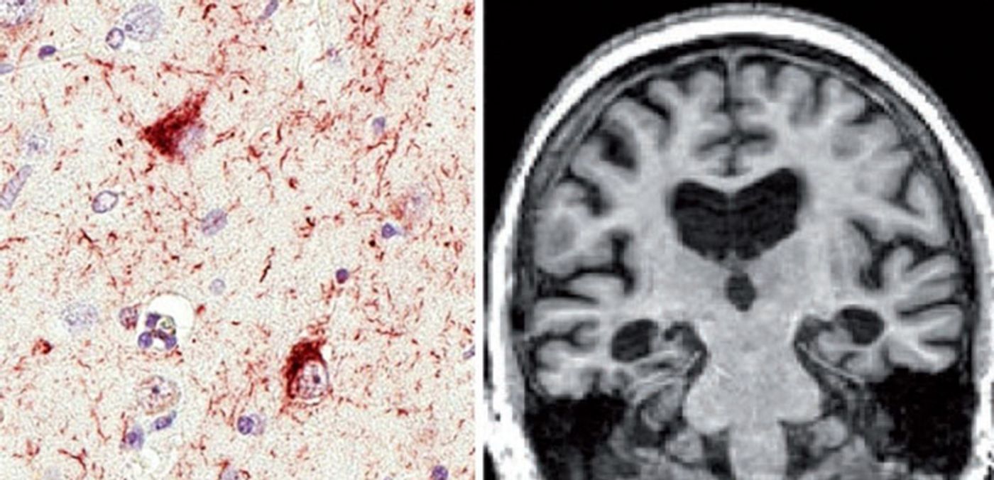 P.T. NELSON ET AL/BRAIN 2019