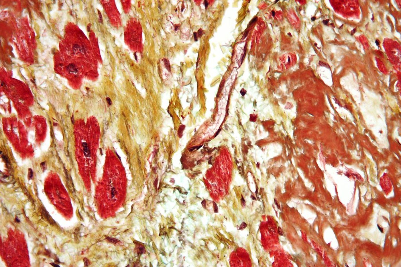 Micrograph of a heart with fibrosis (yellow) and amyloidosis (brown). Credit: Simple Wikipedia