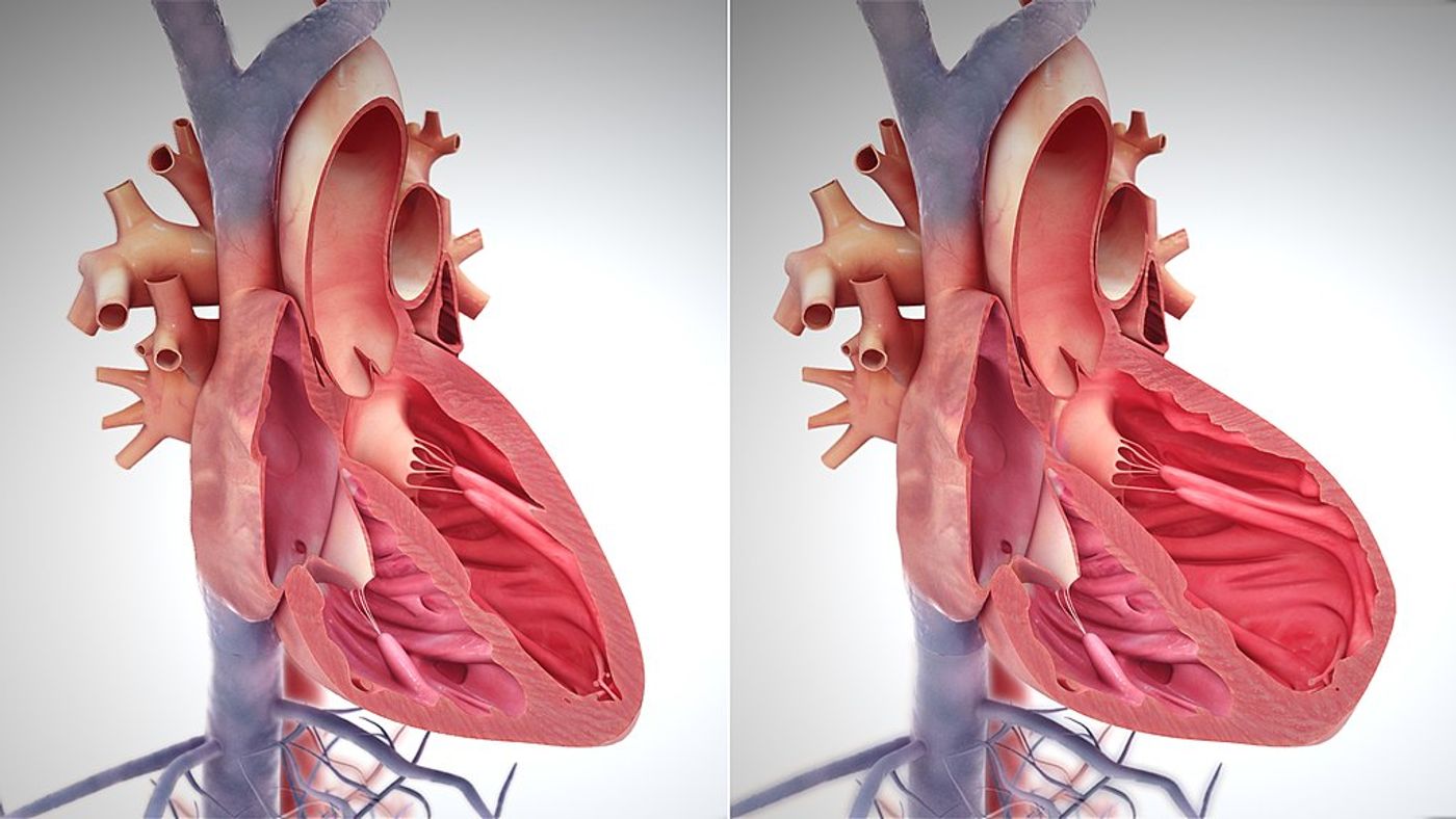 A normal healthy heart (left) and failing heart (right). Credit: Scientific Animations