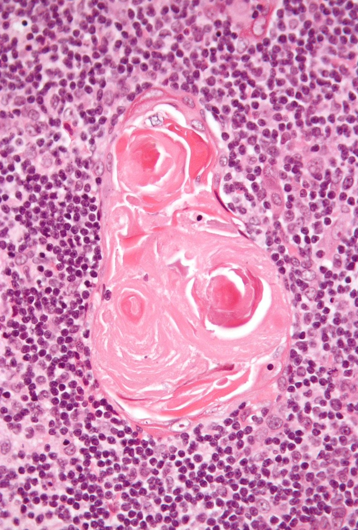 Micrograph of the thymus showing a Hassall's corpuscles. Credit: Nephron