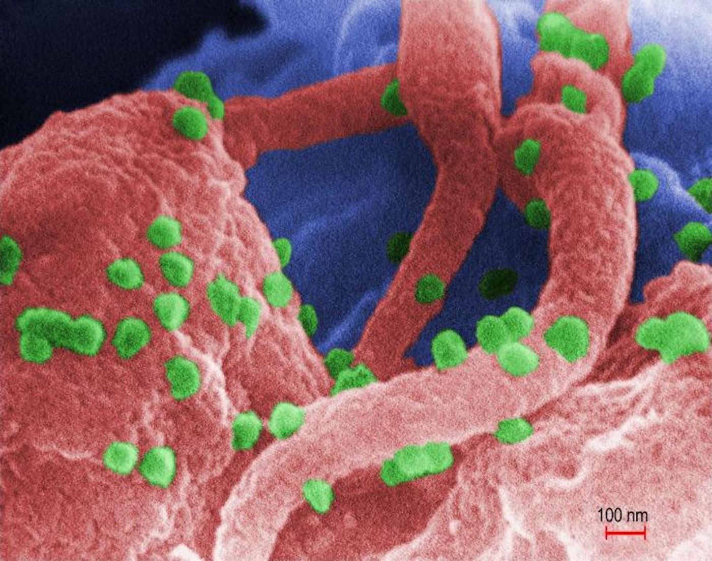 Green particles show the human immunodeficiency virus (HIV-1), in co-cultured with human lymphocytes.