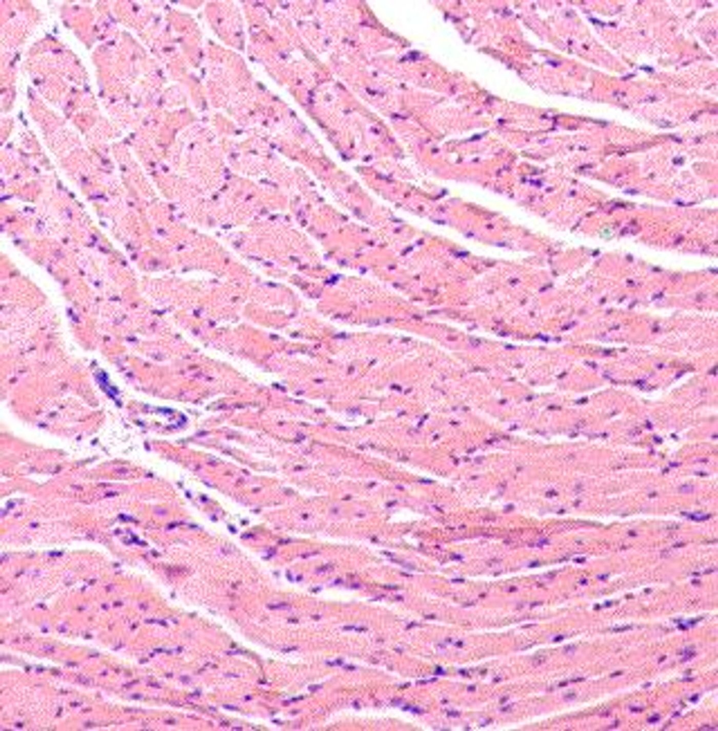 photomicrograph of virus infected heart with inflammation