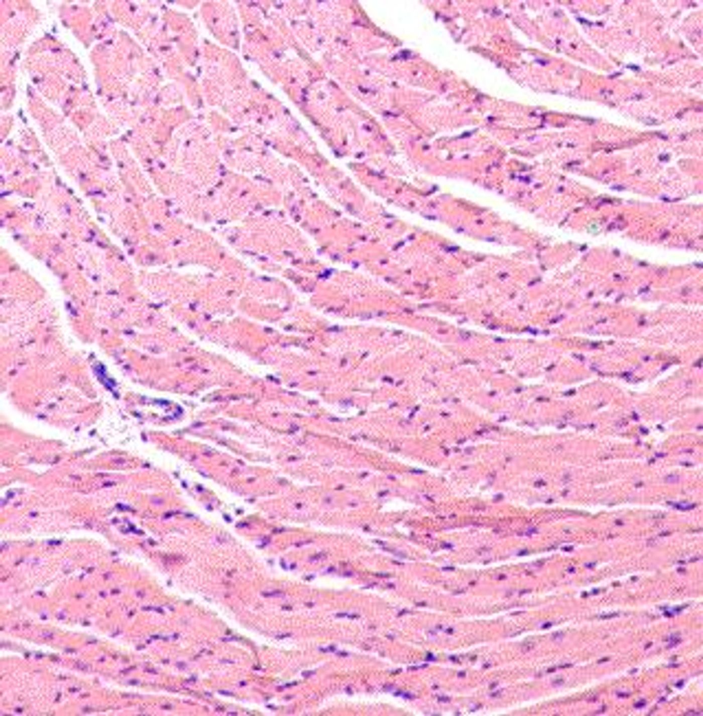 photomicrograph of virus infected heart with inflammation