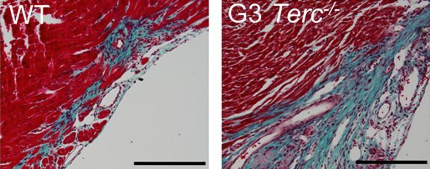 Telomerase-deficient heart tissue (right) with large fibrotic regions (blue) versus wildtype myocardium (left)
