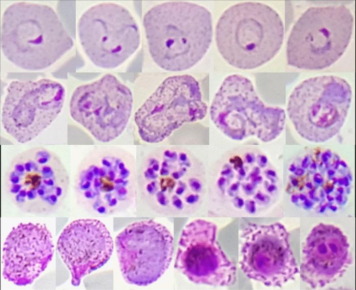 Red blood cell stages of Plasmodium vivax from malaria patients in Thailand.