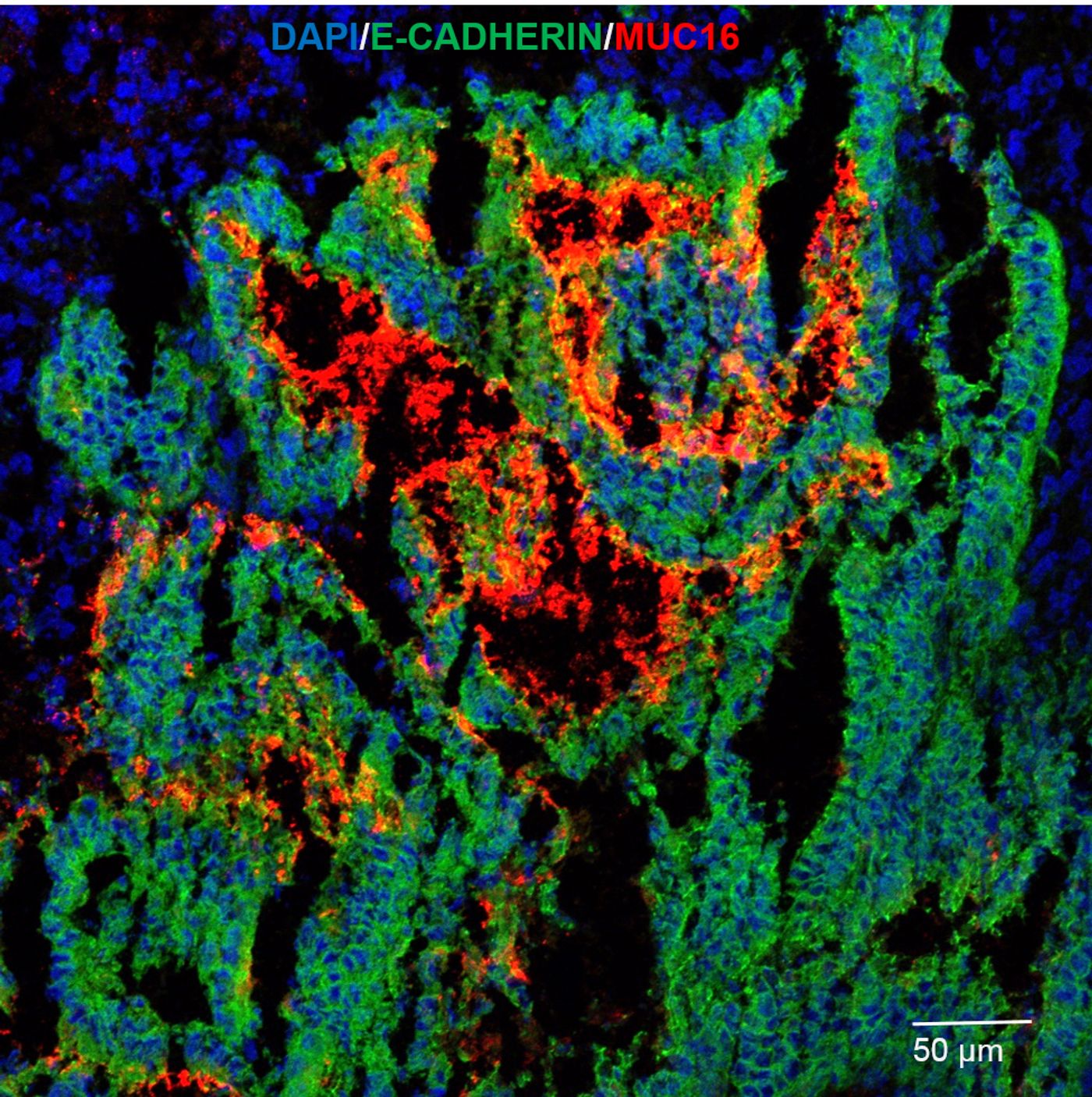 An image of endometrial cancer tissues shows cell nuclei (blue), an epithelial marker protein called E-cadherin (green) and MUC16 glycoproteins (red) that are suspected of protecting tumors. (Credit: Carson Lab/Rice University)