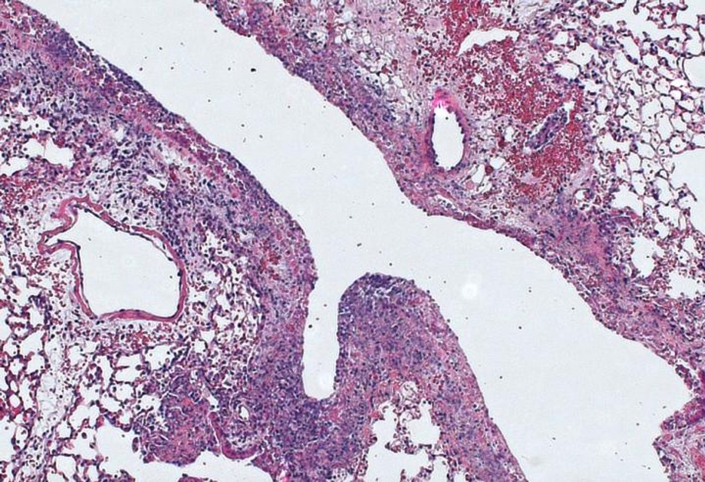 Lung tissue was infected by pneumonia bacteria | Image: Alexandra Bettina