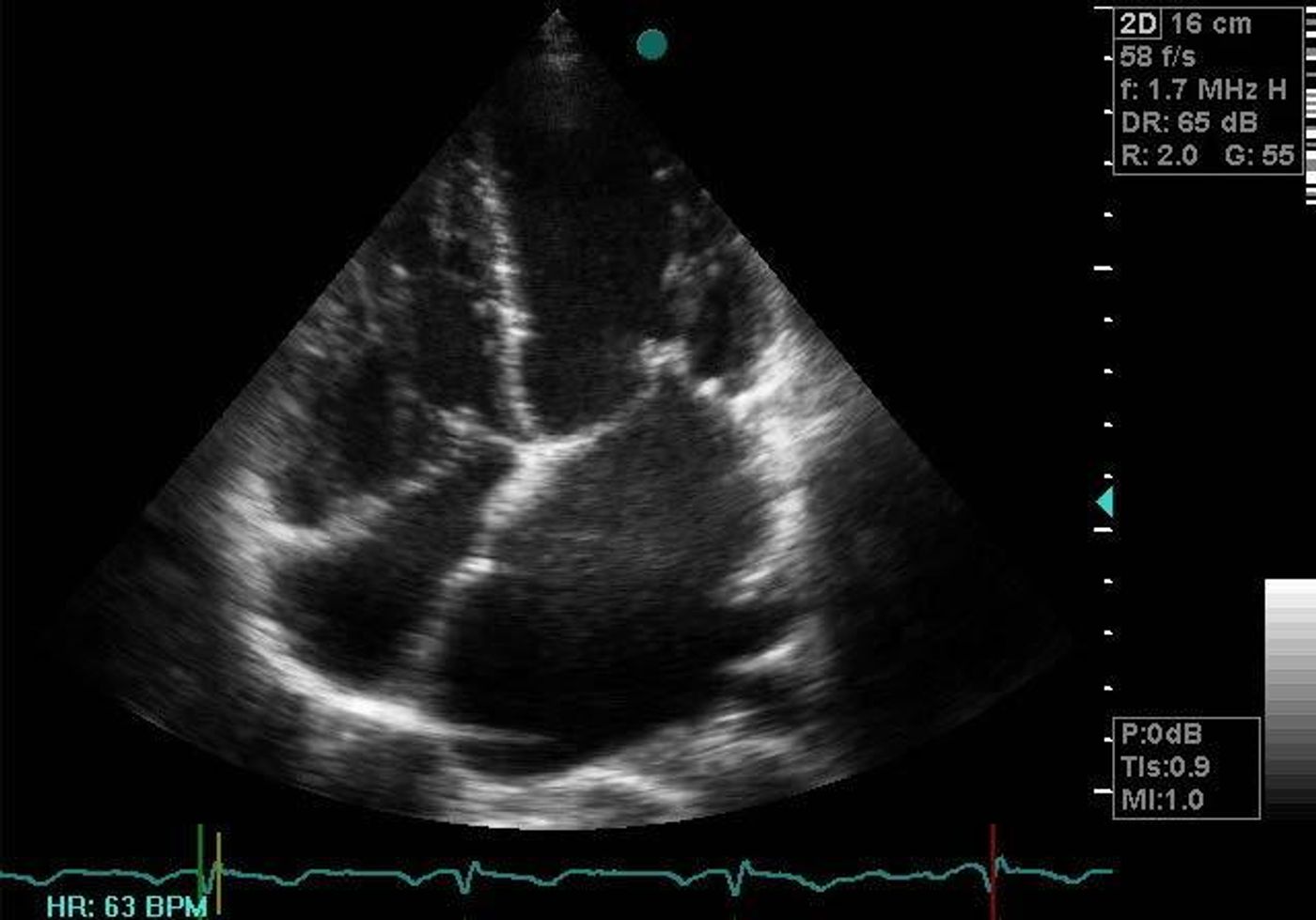 Rheumatic mitral stenosis visualized by transthoracic echocardiogram, South Africa, 2009.