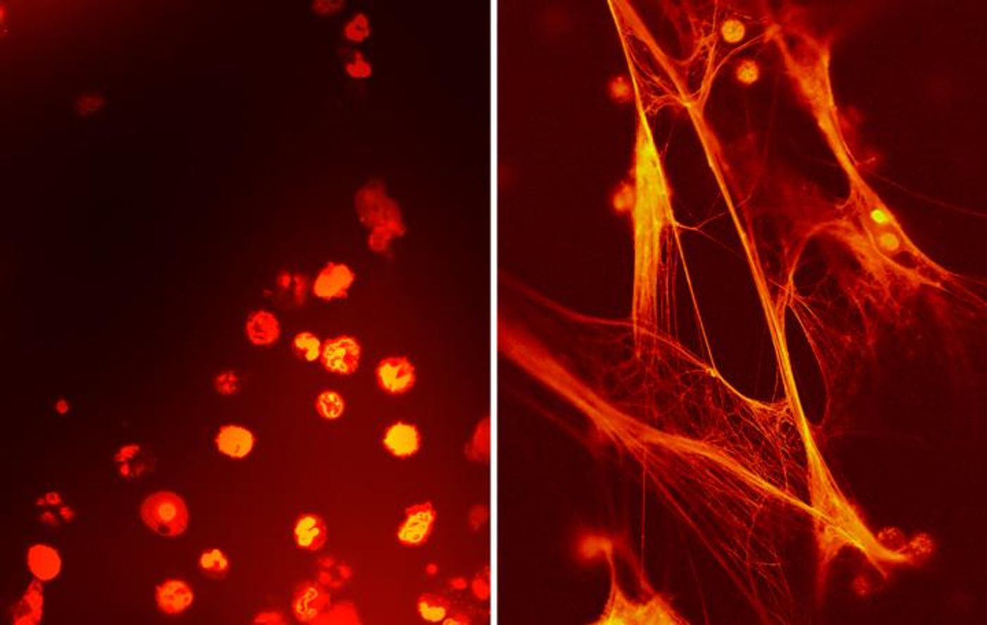 Infection fighting cells from umbilical cord blood (left) and circulating blood three days after birth (right) from the same prematurely born baby.