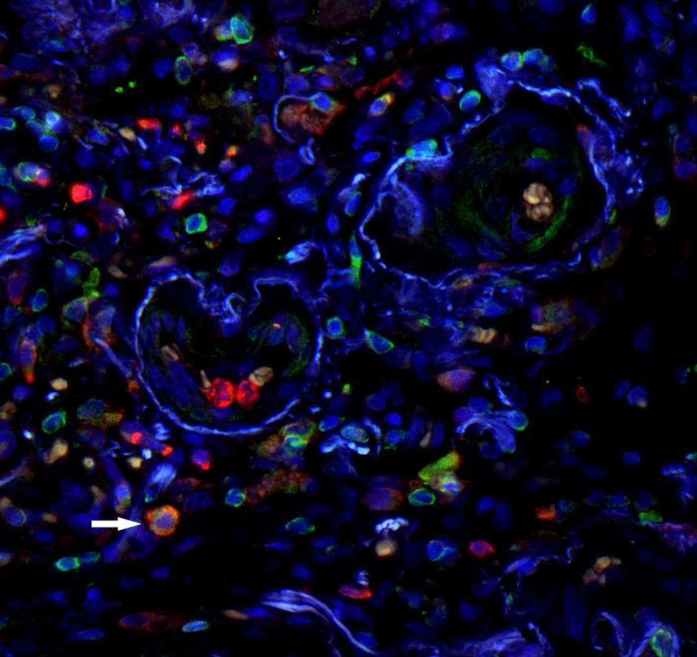 Staining of surface molecules (CD11 in red, CD33 in green) on cells in lung tissue, nuclei in blue. MDSC are positive for both surface markers and consequently appear orange (arrow).