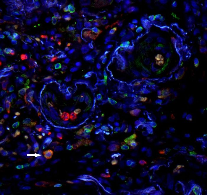 Staining of surface molecules (CD11 in red, CD33 in green) on cells in lung tissue, nuclei in blue. MDSC are positive for both surface markers and consequently appear orange (arrow).