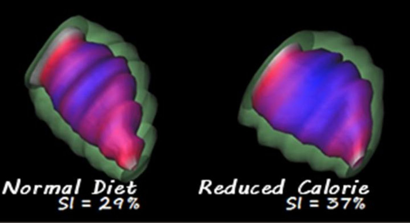 Offspring of undernourished mother has more spherical shaped heart than control. Credit: Dr. Peter Nathanielsz and Dr. Geoffrey Clarke