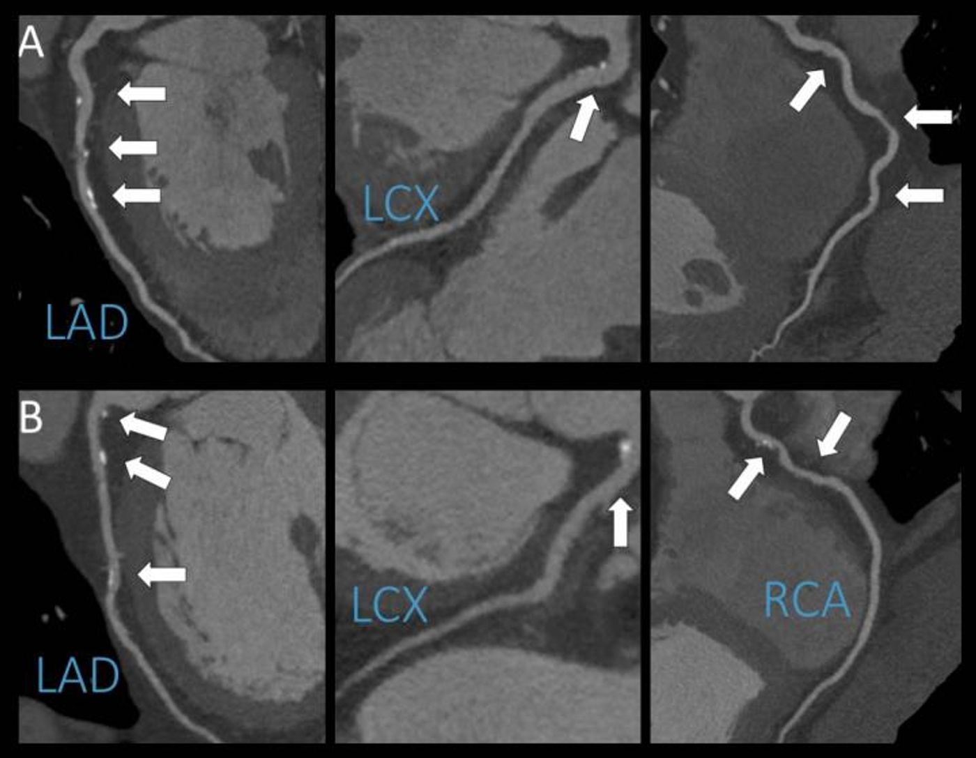 A representative example of coronary CT angiography of a patient who reported no alcohol consumption (panel A) and a patient who reported moderate alcohol consumption (panel B). The age and gender matched patients display the same extent and severity of coronary artery disease. Source: Radiological Society of America