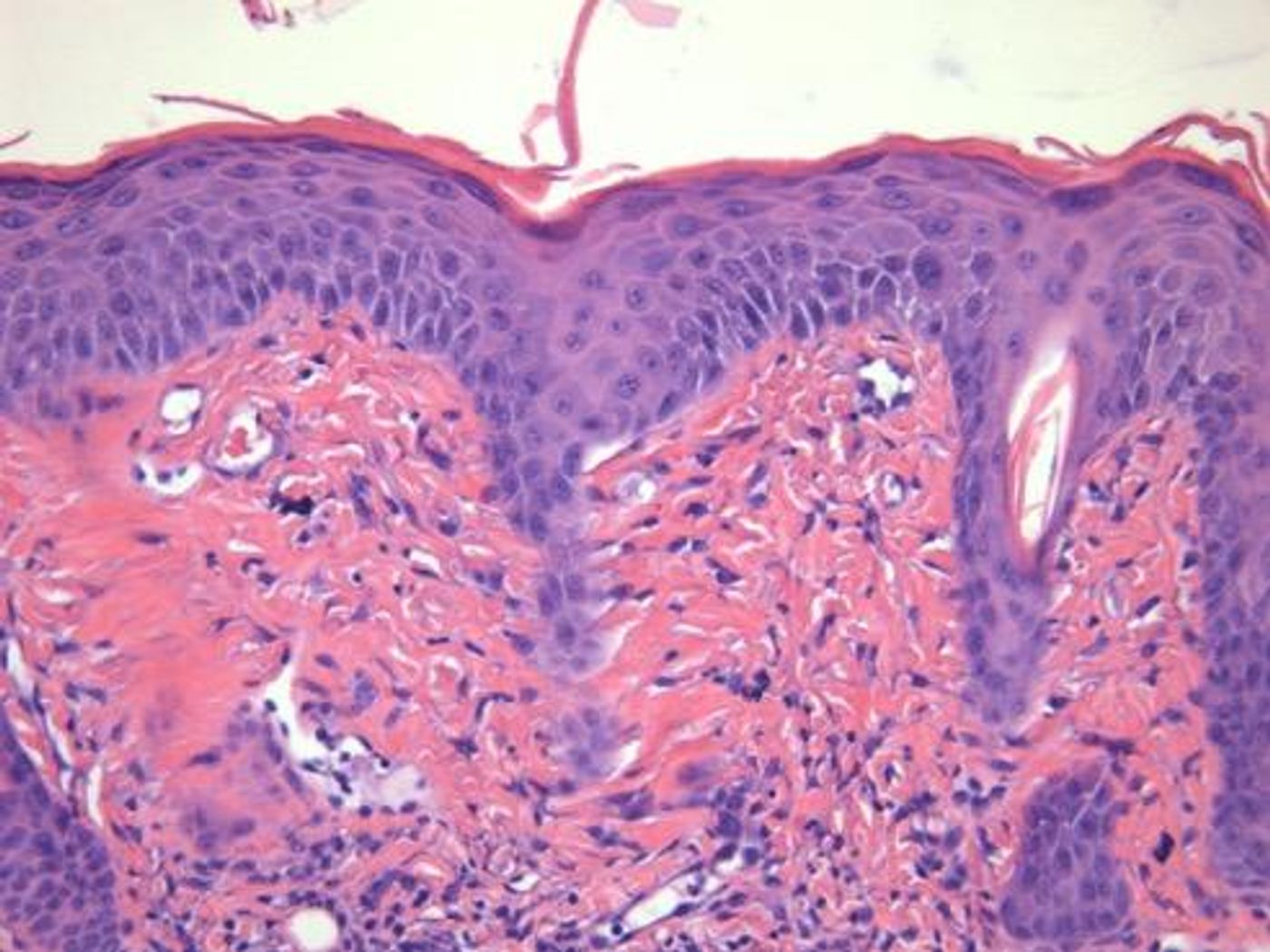 Stained section from back skin of a psoriasis mouse showing characteristic inflammatory cellular responses. Source: Case Western Reserve University School of Medicine