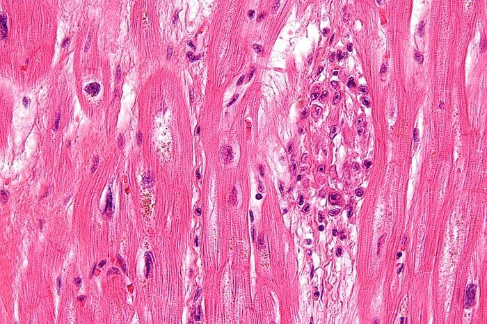 Very high magnification micrograph of rheumatic heart disease. Credit: Wikimedia User Nephron