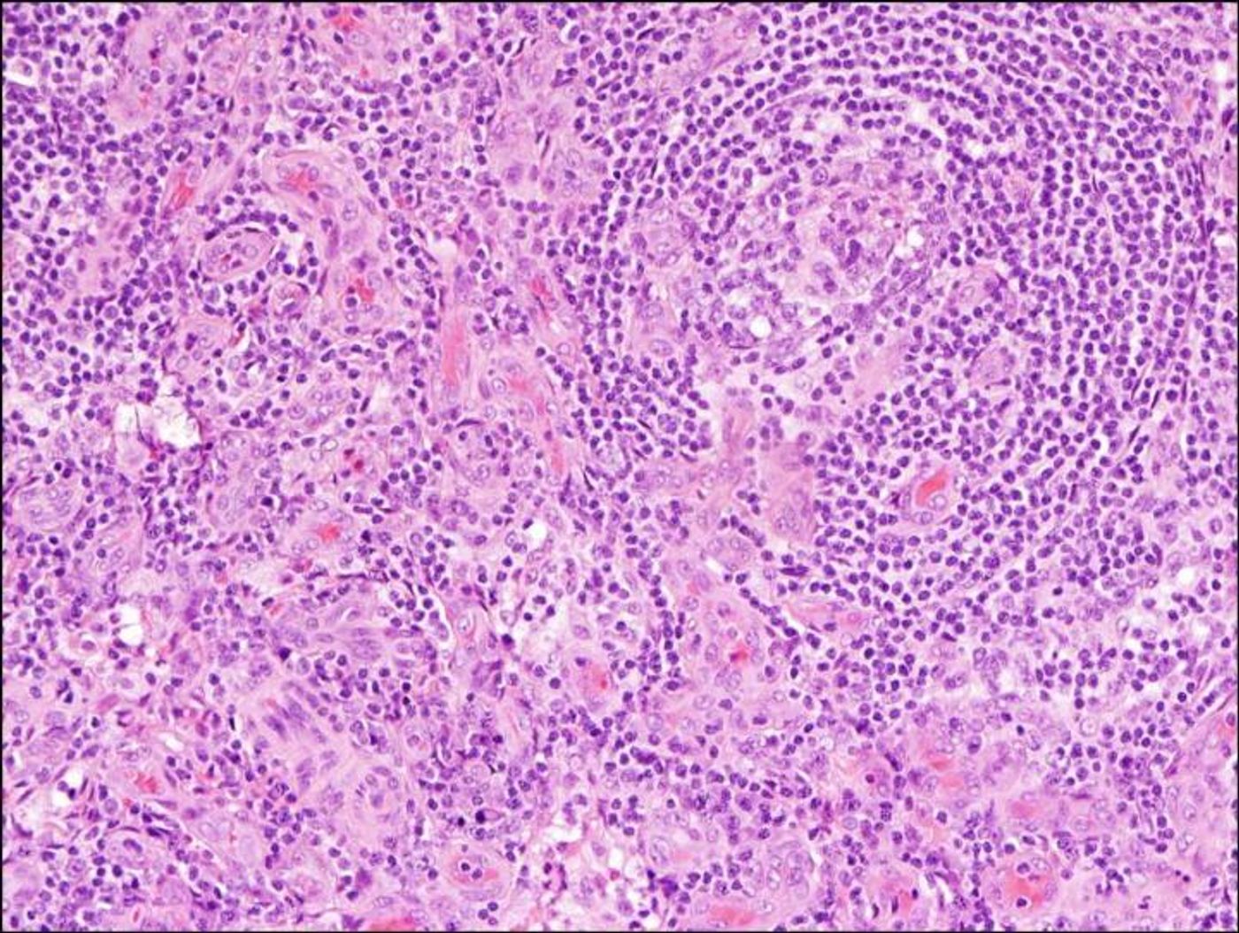 This is an example of lymph node tissue from a person with, idiopathic multicentric Castleman disease. Image shows Increased number of blood vessels and smaller germinal centers where immune cells mature in the lymph node, which are two of the pathology features needed to make the diagnosis. Source: David Fajgenbaum, MD, Perelman School of Medicine, University of Pennsylvania