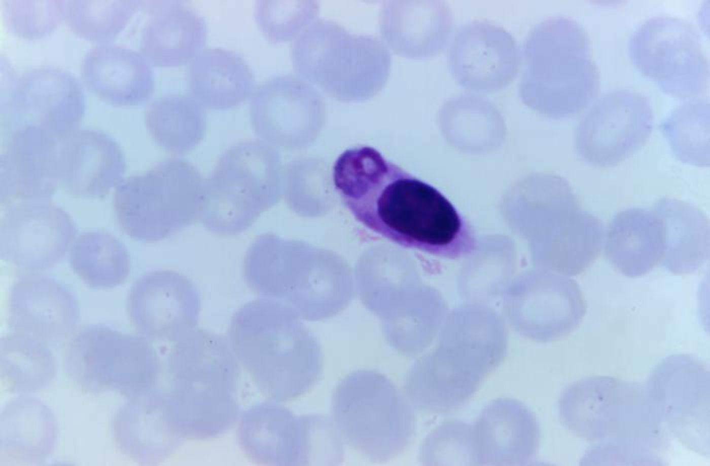 This photomicrograph of a blood smear, revealed a type of white blood cell that had ingested a malaria parasite. / Credit: CDC/ Dr. Mae Melvin