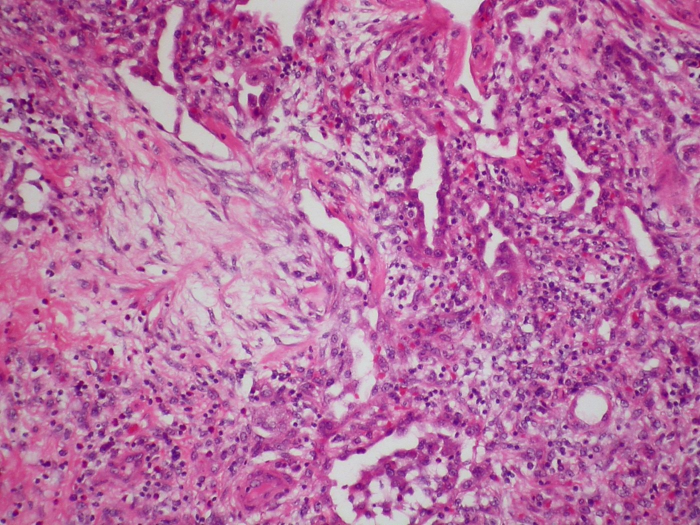 Inflammation and fibrosis in pulmonary lesions of scleroderma patient. Source: Dr. Yale Rosen 