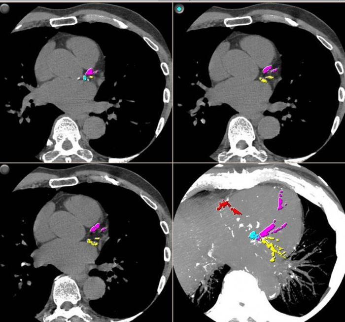CT dataset depicting extensive coronary artery calcification. Credit: Radiological Society of North America