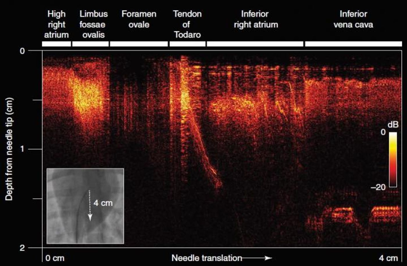 Two-dimensional all-optical ultrasound imaging (B-Mode) acquired during the manual translation of the needle tip across a distance of 4 cm. Credit: Finlay et al.