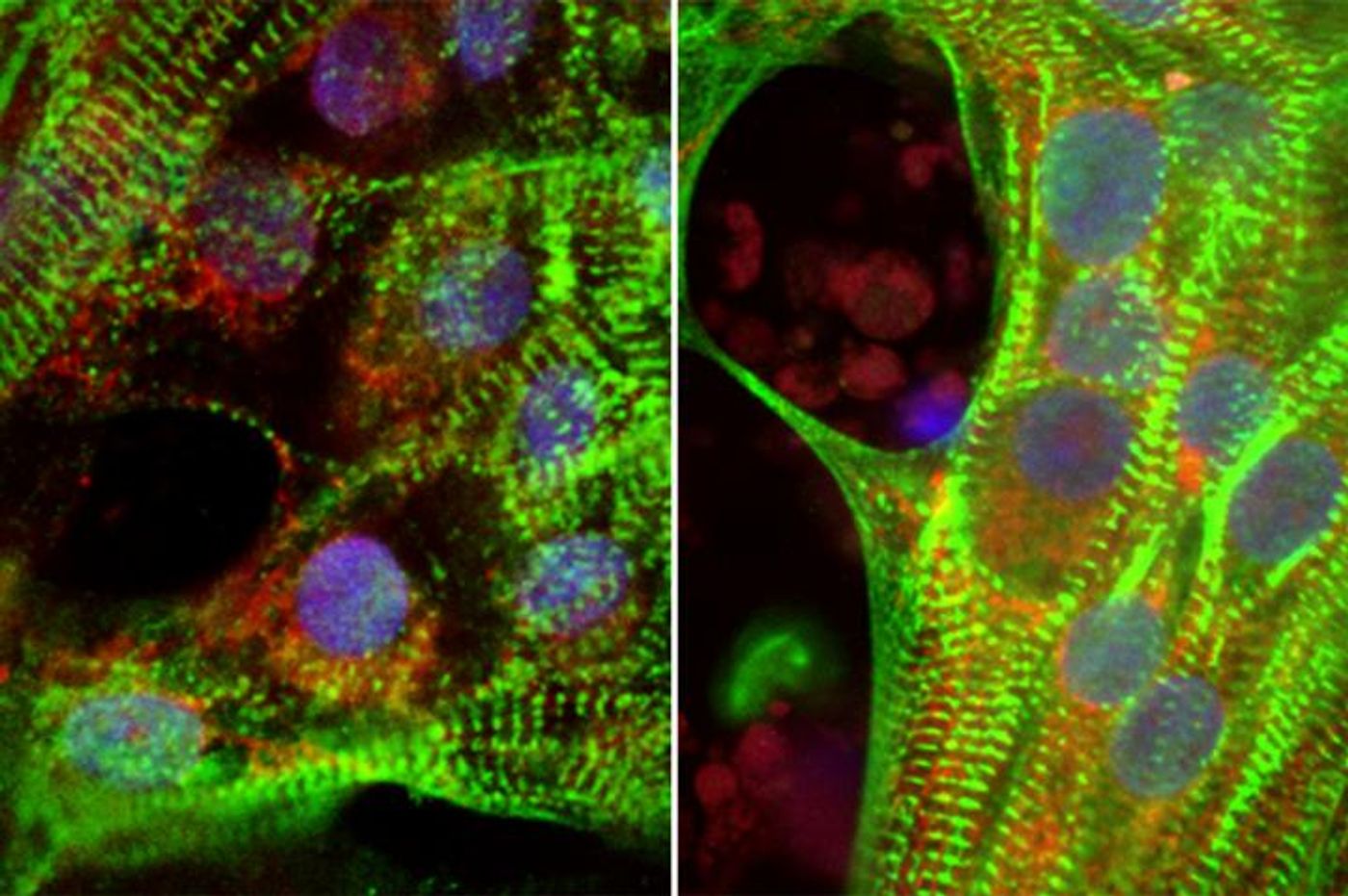 Human heart cells show less robust muscle fibers (green) in high glucose conditions (left) compared to reduced glucose conditions (right).