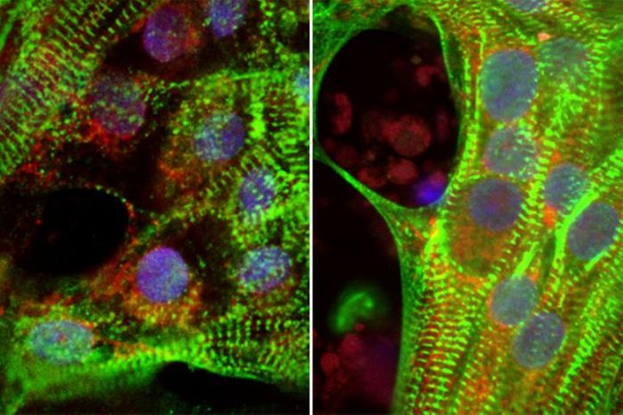 Human heart cells show less robust muscle fibers (green) in high glucose conditions (left) compared to reduced glucose conditions (right).