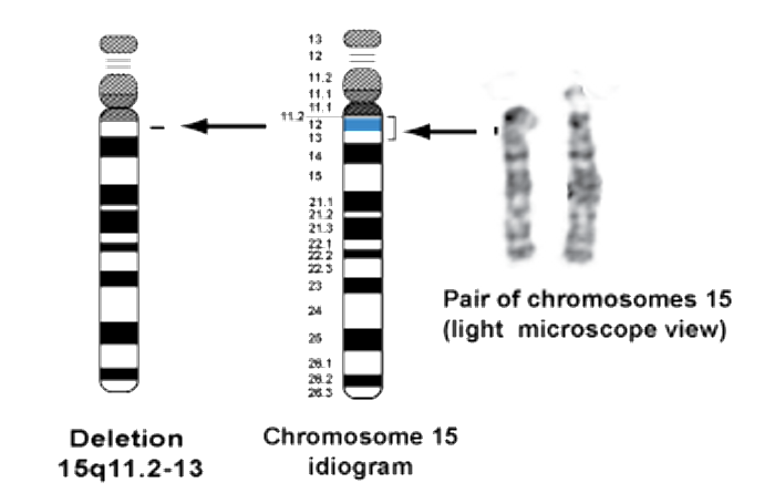 Нарушение 15 хромосомы. Делеция хромосомы. 15 Хромосома человека. Делеция участка хромосомы. Делеция длинного плеча 15 хромосомы.