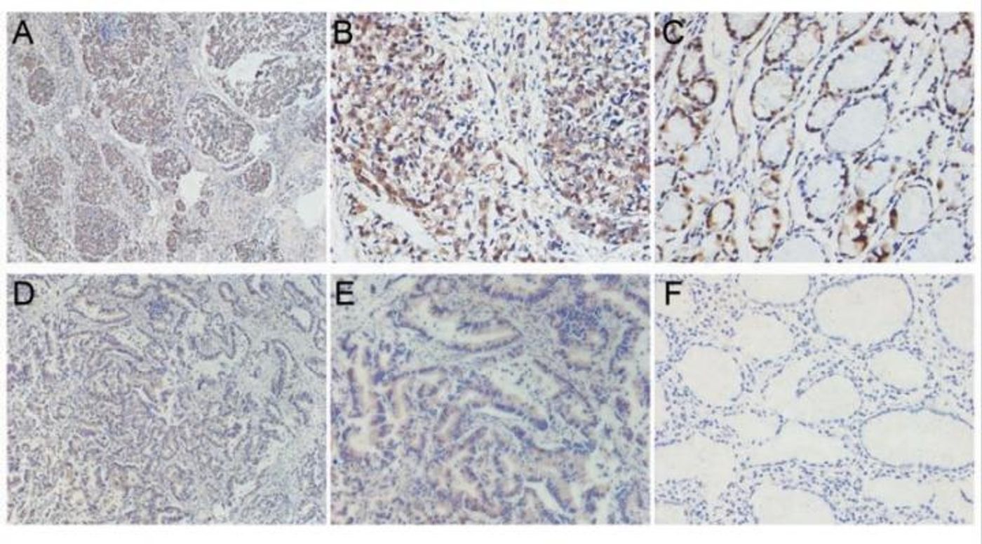 Immunohistochemical staining of transcription factor IIB-related factor 1 (BRF1) in gastric cancer. Credit: The American Journal of Pathology