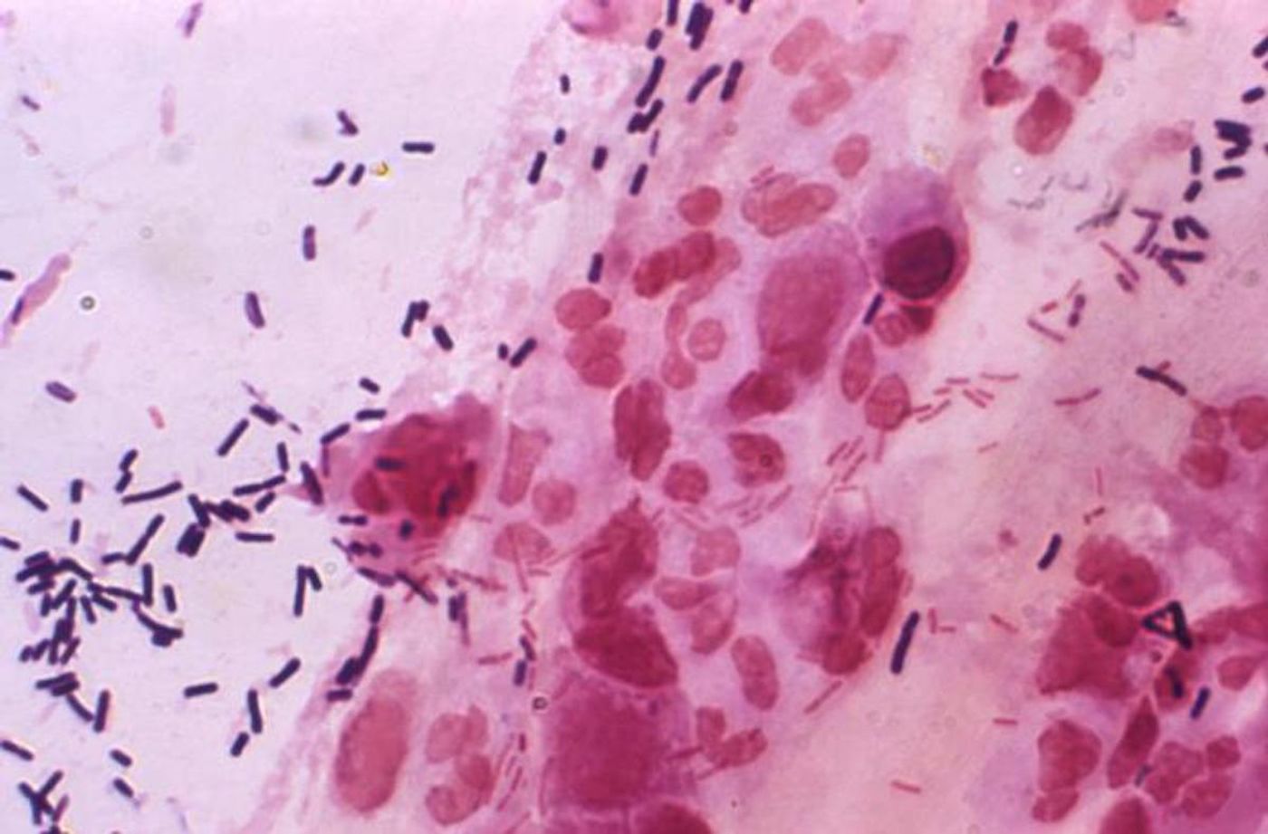 Normal bacterial flora - Gram-positive lactobacilli, and smaller, Gram-negative bacilli - and vaginal epithelial cells are seen in this Gram-stained vaginal smear specimen / Credit: CDC / Joe Miller
