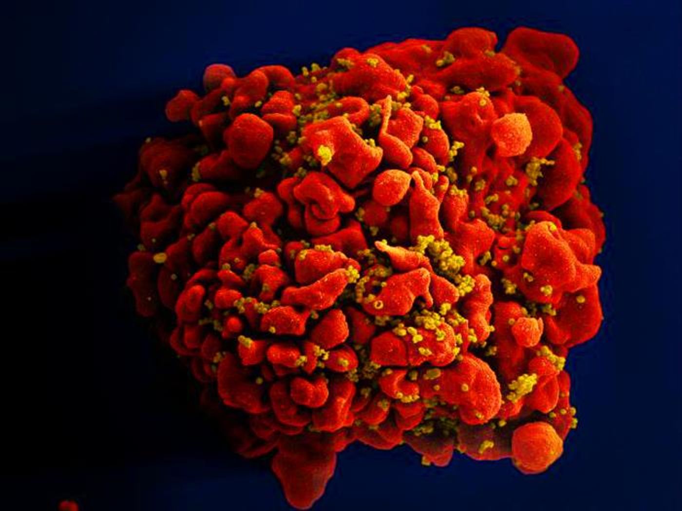 A digitally colorized scanning electron microscopic image depicting one red-colored, H9-T cell infected by spheroid shaped, mustard-colored human immunodeficiency virus (HIV) particles / Credit: National Institute of Allergy and Infectious Diseases