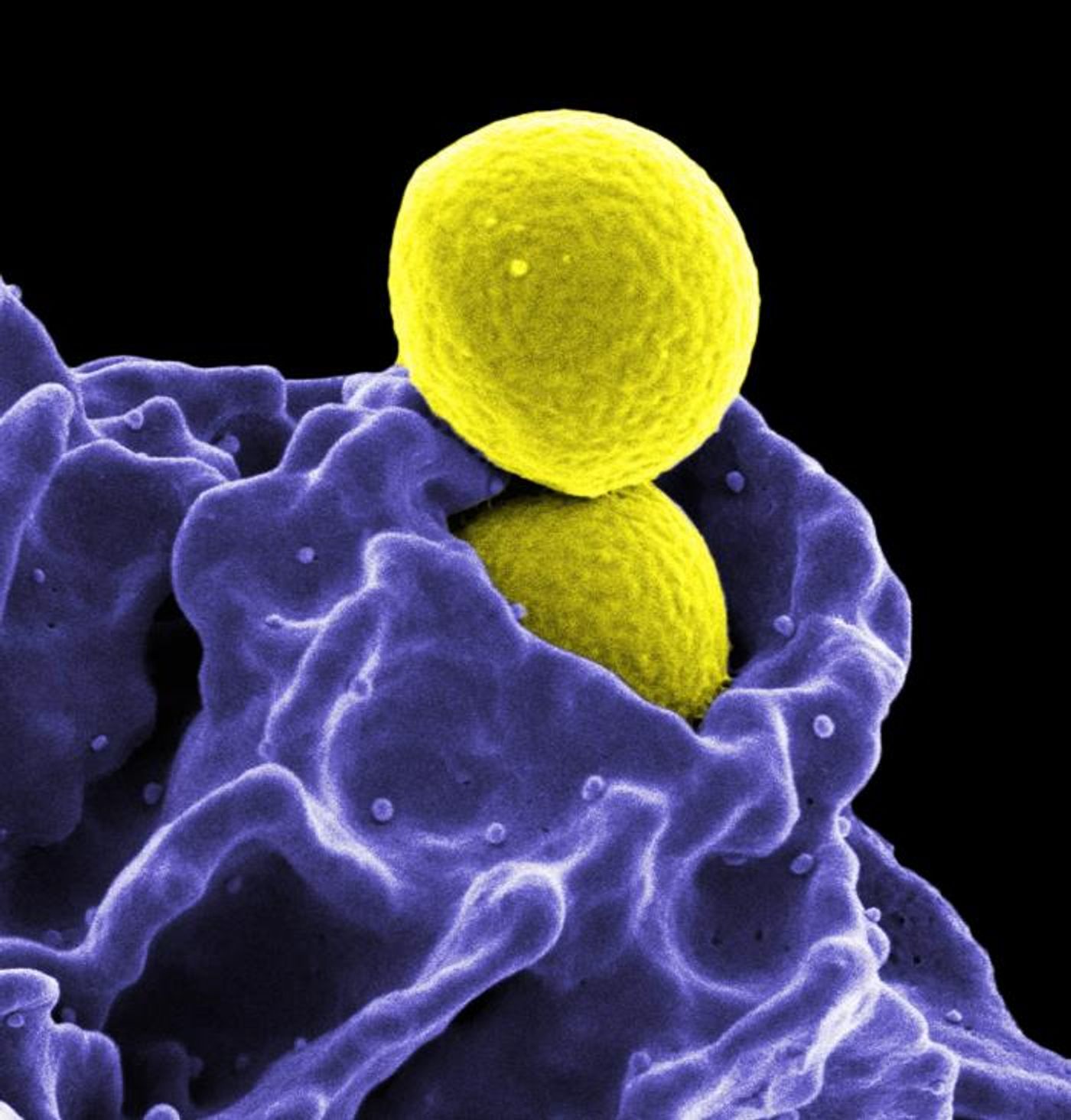Two yellow-colored, spherical methicillin-resistant, Staphylococcus aureus (MRSA) bacteria, in the process of being phagocytized by a blue-colored human white blood cell (in this case, a neutrophil)./ Credit: National Institute of Allergy and Infectious Diseases