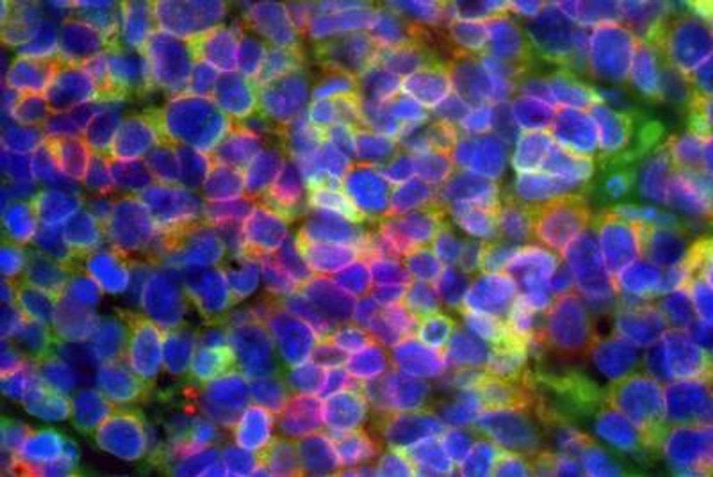 Microscopic image of small cell neuroendocrine prostate cancer: cancer cells are seen expressing diagnostic prostate cancer markers in green and red (blue color indicates the cell nucleus) / Credit: Jung Wook Park & Owen Witte