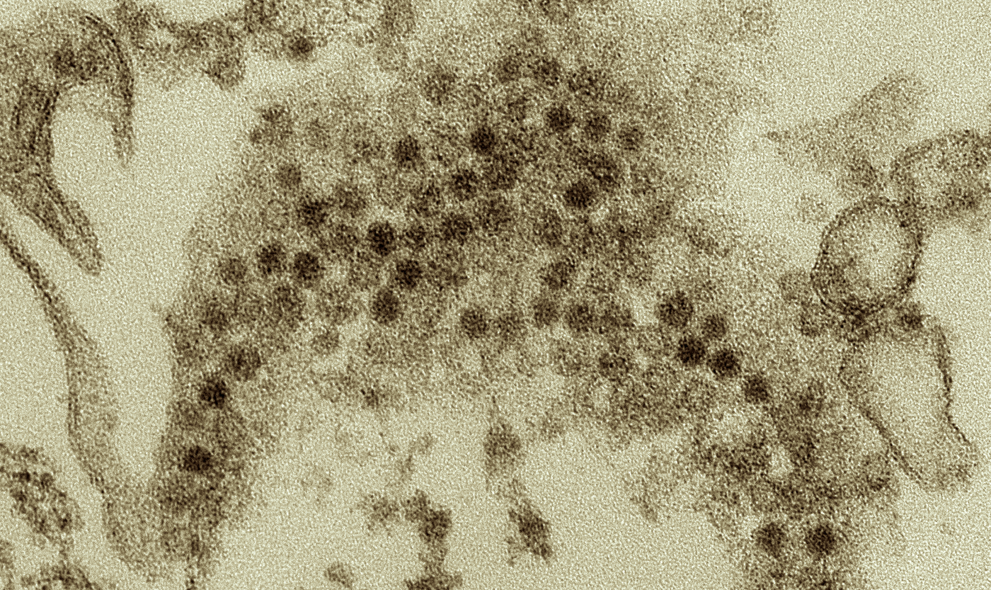 A TEM image of numerous, spheroid shaped Enterovirus-D68 (EV-D68) virions, which are members of the family Picornaviridae. Some viral particles appear empty, missing their single-stranded RNA / Credit: CDC/ Cynthia S. Goldsmith, Yiting Zhang