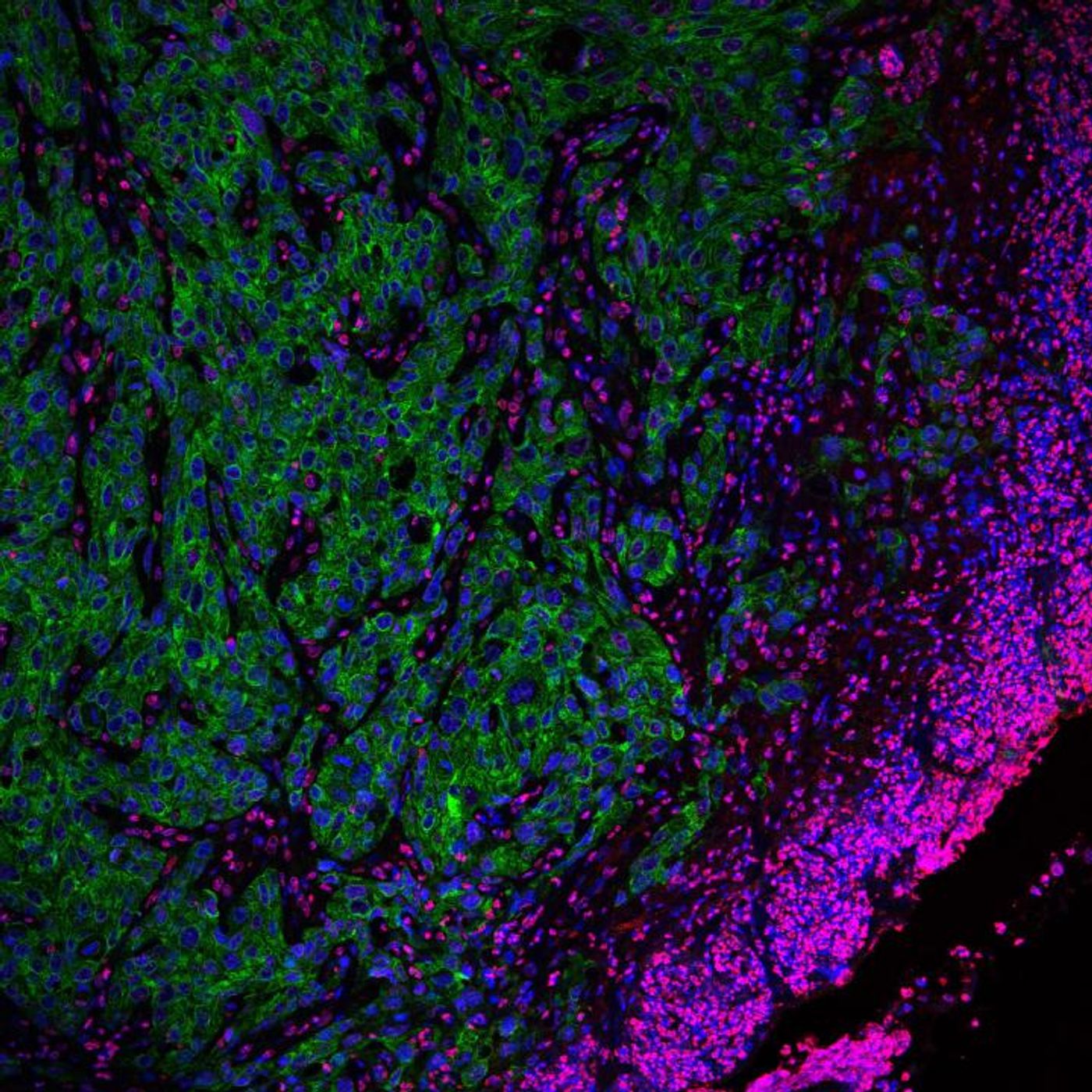 A invasive front of highly aggressive tumor cells (in green). / Credit: Alexandra Avgustinova, IRB Barcelona.