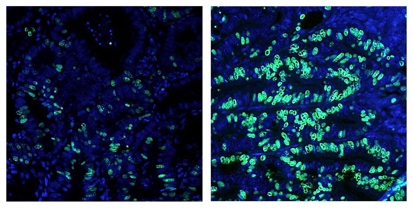 Colon cancer growth, as measured by the number of dividing cells shown in green, is dramatically increased when the FXR-regulated gene network is disrupted by specific bile acids or a high-fat diet. / Credit: Salk Institute