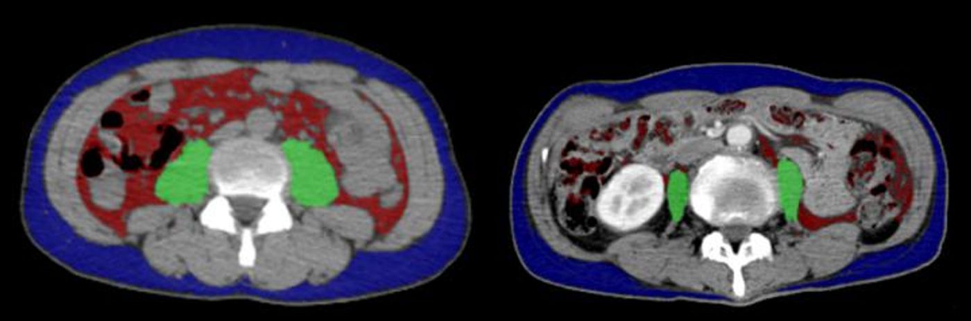 Two lung cancer patients - cross-section of the psoas major muscle (green); non-sarcopenic (left), sarcopenic (right) / Credit: Osaka University