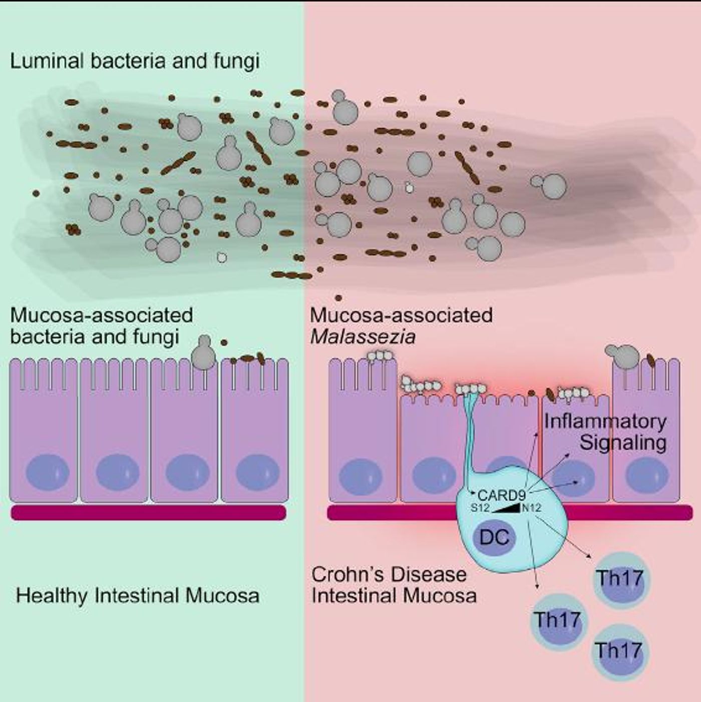 This visual abstract depicts the findings of Limon et al., who surveyed intestinal wall associated fungi in patients with Crohn's disease (CD) and healthy controls and found a common commensal skin yeast called Malassezia, preferentially in CD patients. Malassezia exacerbates colitis in mouse models through mechanisms requiring CARD9, a signaling protein involved in anti-fungal immunity. / Credit: Limon et al.