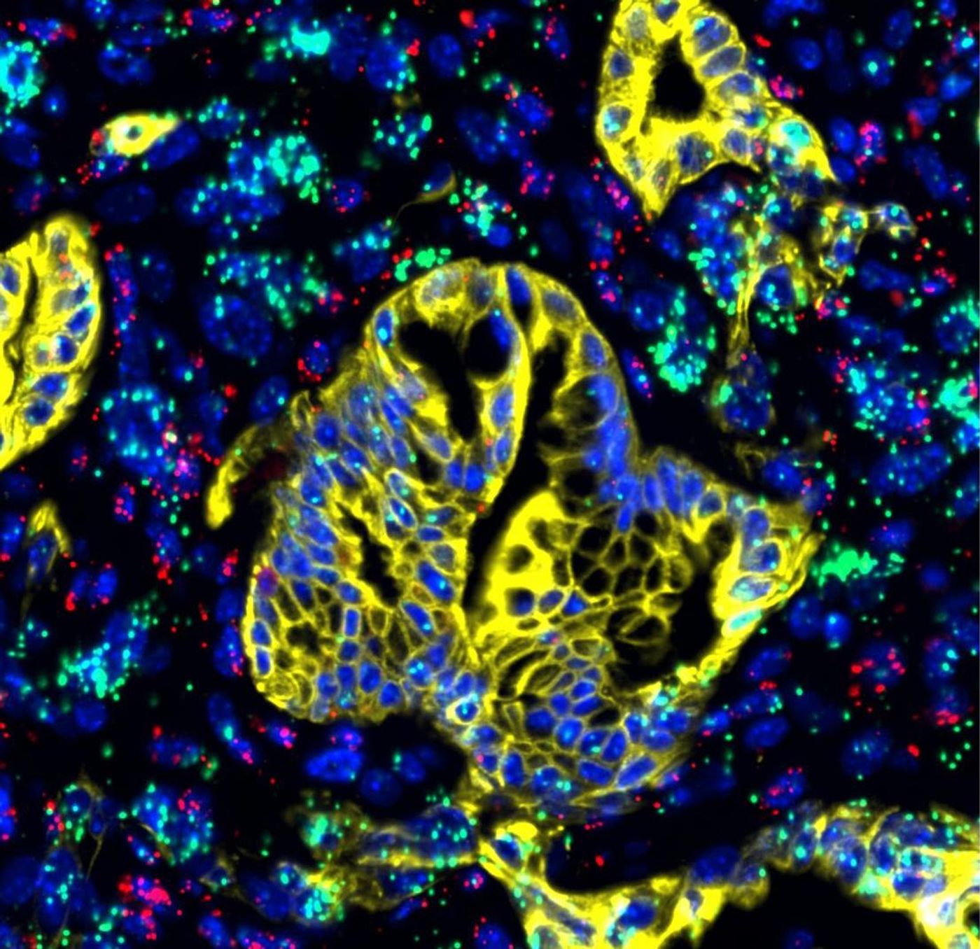 LIF (green), expressed mainly in activated pancreatic stellate cells, is shown along with immune cells (purple) and cancer cells (yellow) in pancreatic cancer tissue. / Credit: Salk Institute