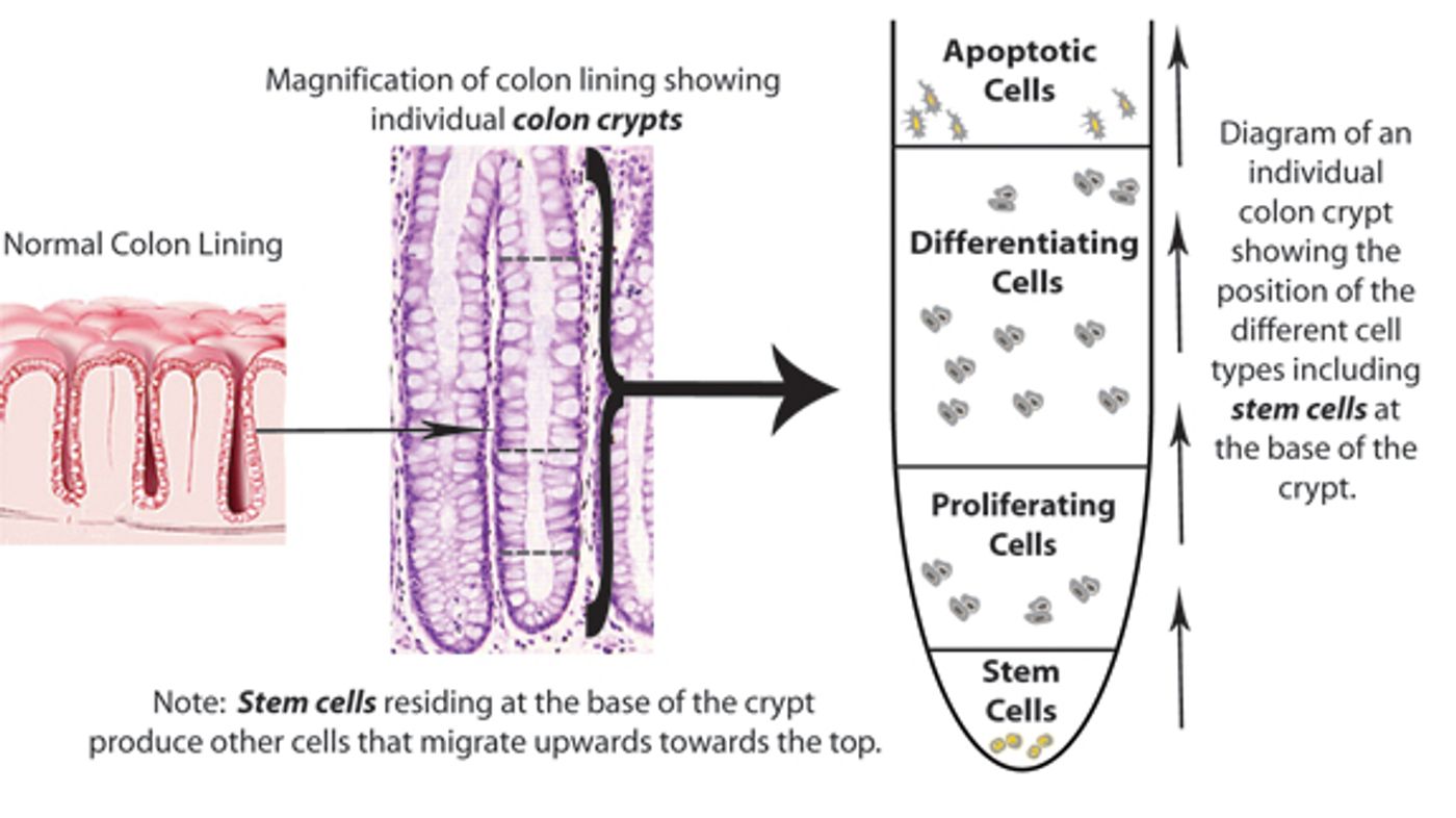 Credit: Analysis of Proteomic Alterations during Human Colorectal Tumorigenesis by Anuli Uzozie