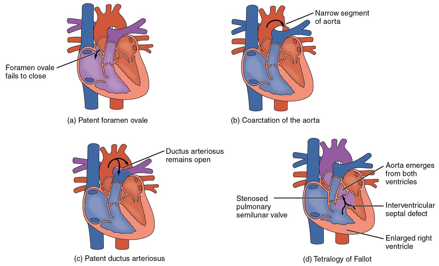 Type of Congenital Heart Defects