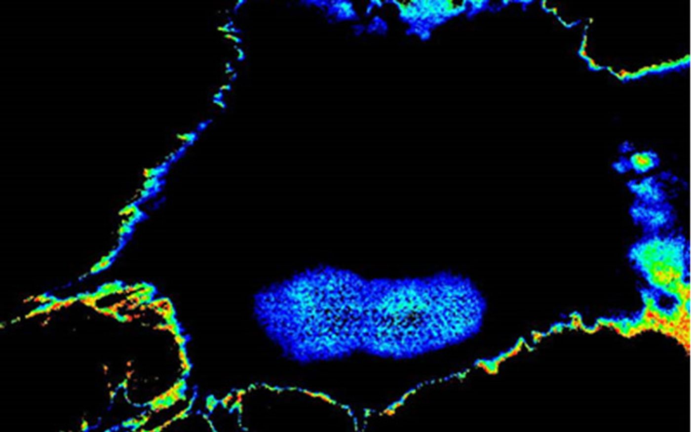 A tumor cell that has acquired high metastatic potential during chemotherapy lights up with high FRET biosensor readout, whereas the cells that are sensitive to chemotherapy (and hence, low potential) stays dark. Credit: UC San Diego News Center