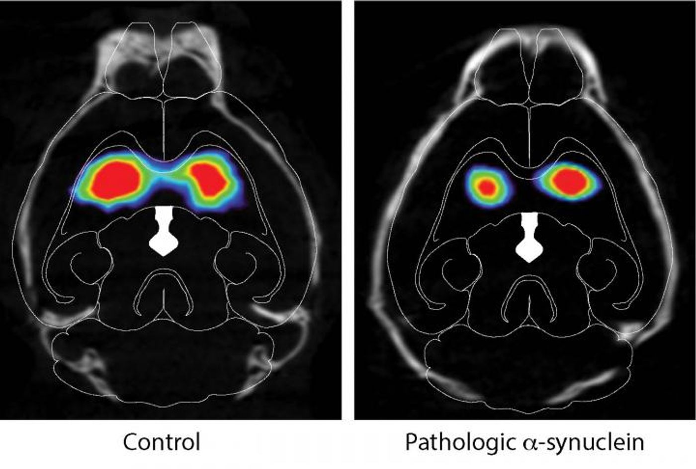 The images are of DAT scans of mice injected in gut with pathologic alpha-synuclein on the right and control injected animals on the left. Note the loss of dopamine in the striatum of mice injected with pathologic alpha-synuclein. / Credit: Ted Dawson et al. / Neuron, 2019