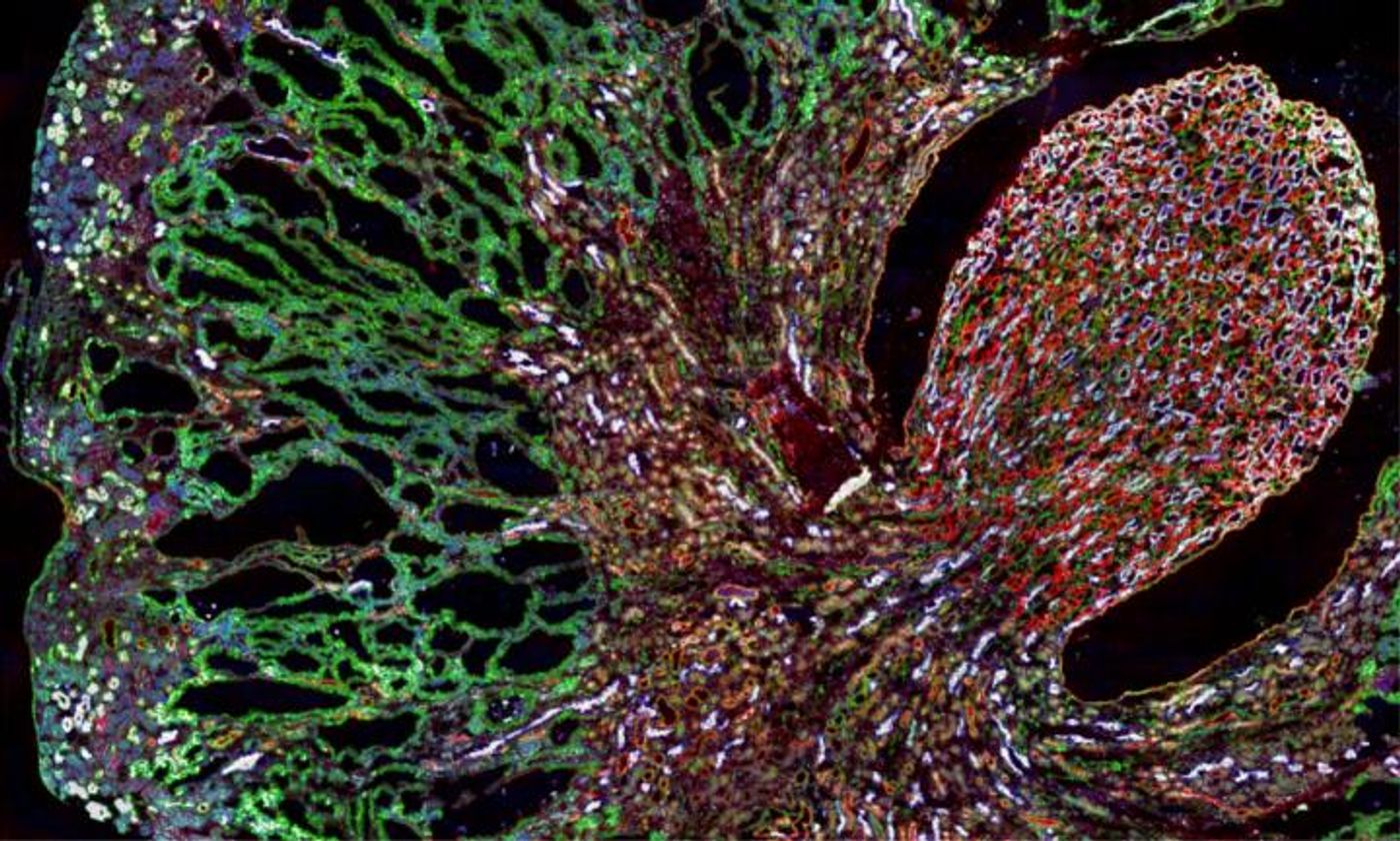 Misfolded MUC1-fs protein (green) builds up in the kidneys of a mouse model of MUC1 kidney disease. / Credit: Dvela-Levitt M, et al. Cell. 2019